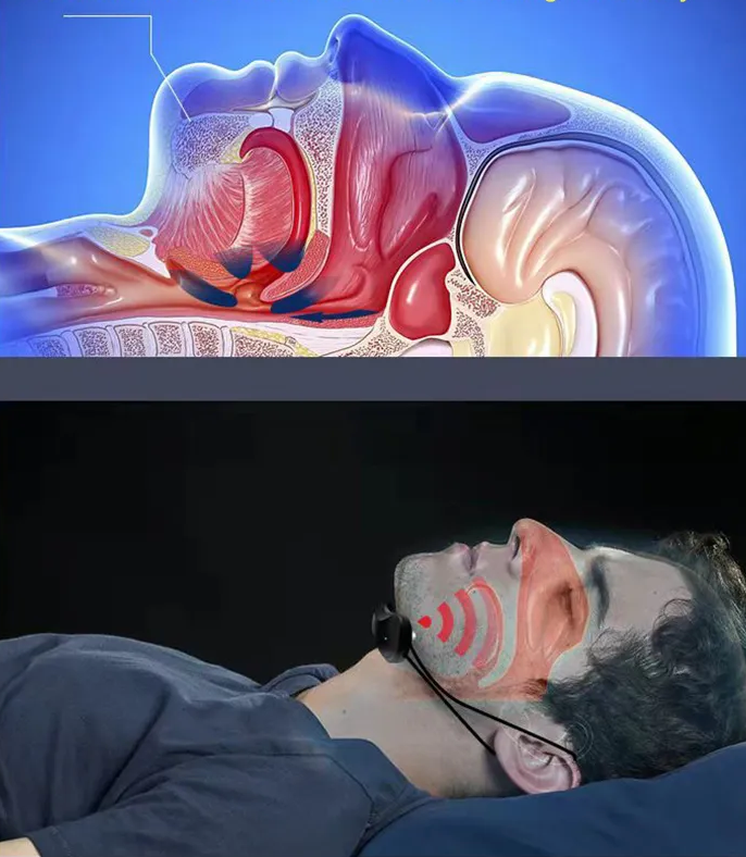 Knarkimą slopinantis prietaisas - Originalu-pigu